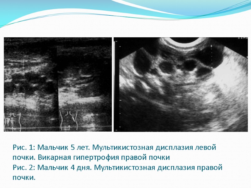 Рис. 1: Мальчик 5 лет. Мультикистозная дисплазия левой почки. Викарная гипертрофия правой почки Рис.